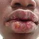 Can Herpes Simplex Be Cured?