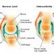 Picture of Osteoarthritis