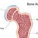 Osteopenia