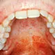 Does Oral Sex Cause Palatal Petechiae?