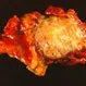 Picture of Pancreatic Cancer Tumor