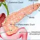 Pancreatitis