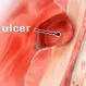 Peptic Ulcer