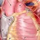 Pericarditis