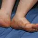 Picture of Peripheral Vascular Disease