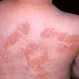 Picture of Phytophotodermatitis