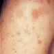 Picture of Pityriasis Lichenoides