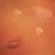 Picture of Pityriasis Rosea 2