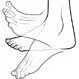 Plantar Fasciitis