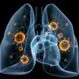 How Serious Is Pneumococcal Pneumonia?