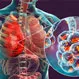 What are the Three Major Causes of Pneumonia?