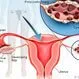 Picture of Polycystic Ovary Syndrome