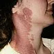 Picture of Port-Wine Stain (Neck)