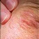 Picture of Psoriasis 1