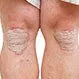 Picture of Psoriasis 2