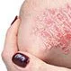 Picture of Psoriasis 3