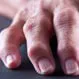 Psoriatic Arthritis