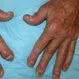 Picture of Psoriatic Arthritis