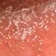 Picture of Pustular Psoriasis