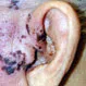 Ramsay Hunt Syndrome