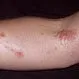 Picture of Rash from Poisonous Plants