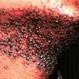 Picture of Razor Bumps