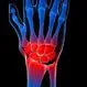 Reactive Arthritis