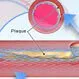 Renal Artery Stenosis