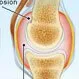 Rheumatoid Arthritis (RA)