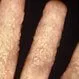 Picture of Ringworm of the Hand