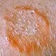 Picture of Ringworm