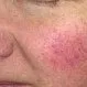 Picture of Rosacea 1