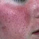 Picture of Rosacea 2