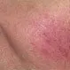 Rosacea