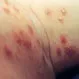 Picture of Scabies 1