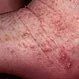 Picture of Scabies 3