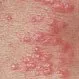 Picture of Scabies