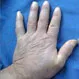 Scleroderma