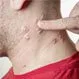 Can You Have a Mild Case of Shingles?