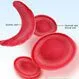 Sickle Cell Disease (Anemia)