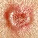 Picture of Skin Cancer