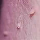 Picture of Skin Tag