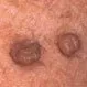 Picture of Skin Tags