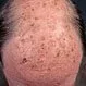 Picture of Solar Keratosis