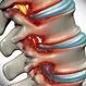 Is Spinal Stenosis a Serious Condition?