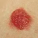 Picture of Spitz Nevus