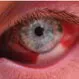 Subconjunctival Hemorrhage