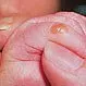 Picture of Sucking Blister