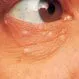 Picture of Syringoma