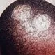 Picture of Tinea Capitis